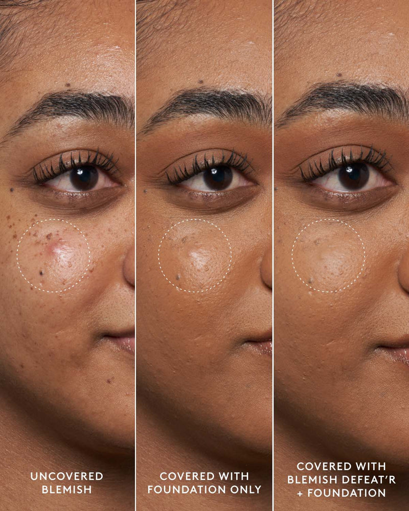 Close-up of model's medium-toned face showing an uncovered blemish, a foundation-covered blemish and a foundation and Blemish Defeat'r BHA Spot-Targeting Gel-covered blemish.