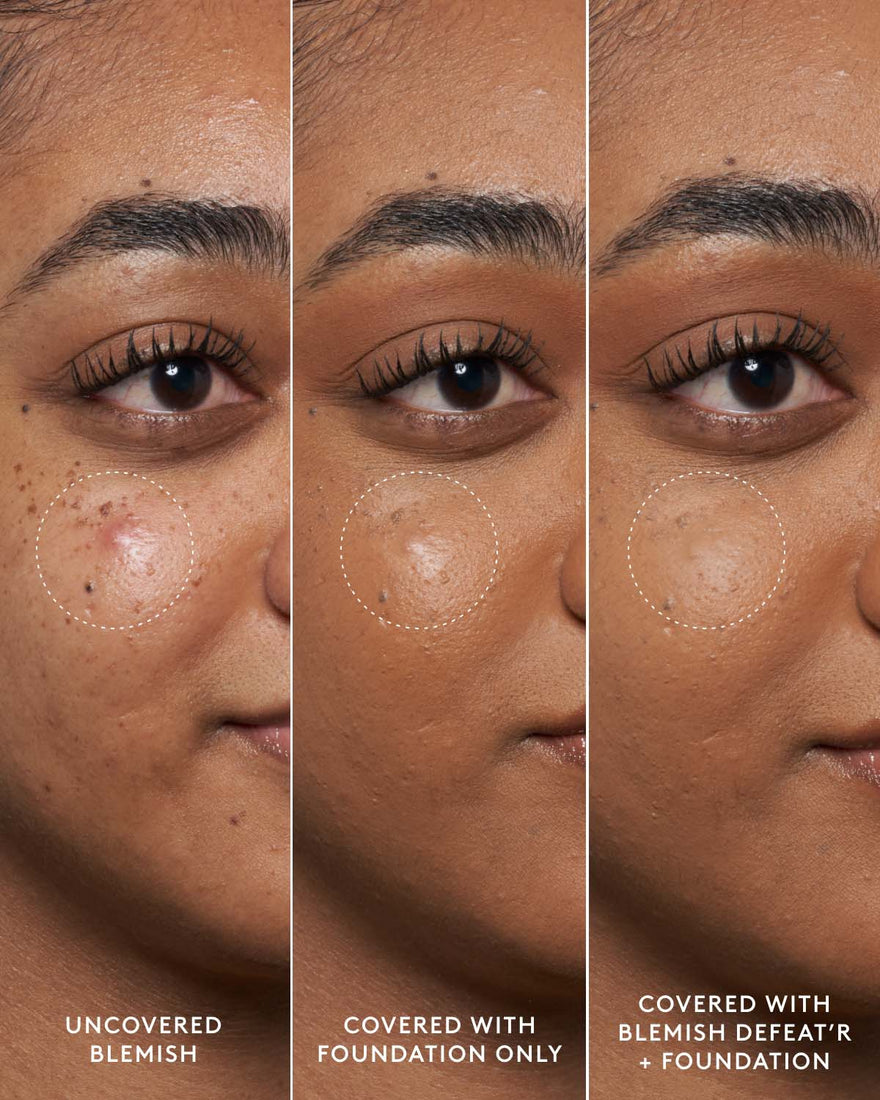 Close-up of model's medium-toned face showing an uncovered blemish, a foundation-covered blemish and a foundation and Blemish Defeat'r BHA Spot-Targeting Gel-covered blemish.