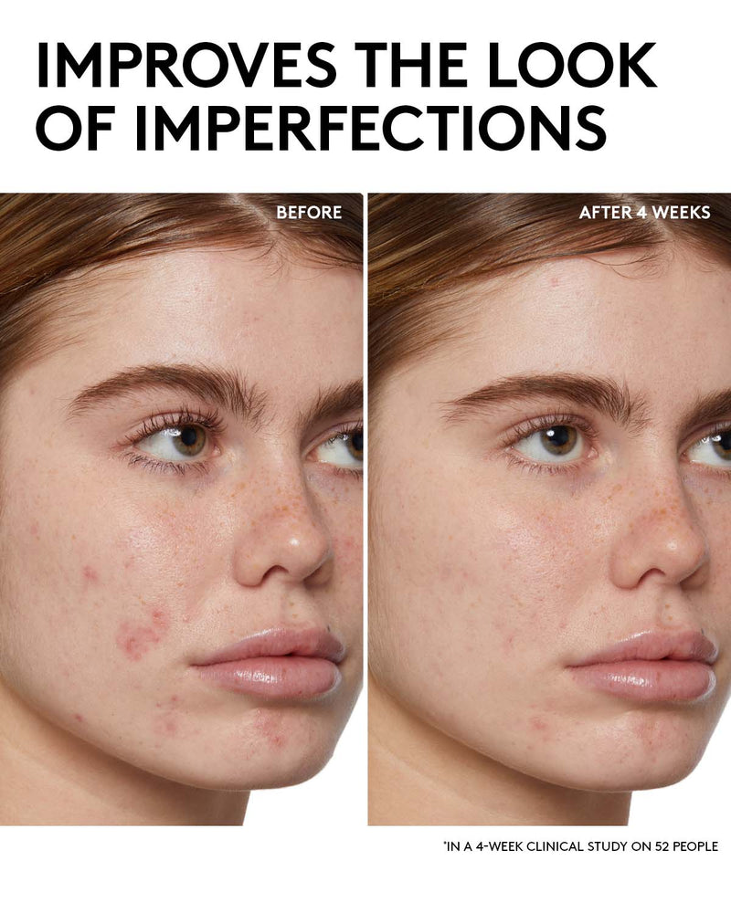 Improves skin clarity in 1 week in a 4-week clinical study on 52 people. Before and After image of model that used Cherry Dub BHA Toner with Salicylic Acid + Aloe Juice.